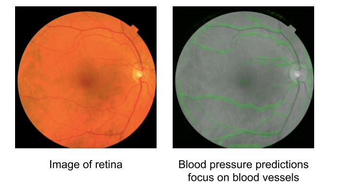 谷歌使用深度学习分析视网膜图像来识别心脏病