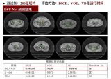 英特尔利用人工智能辅助宫颈癌治疗
