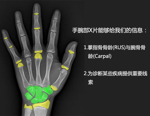 一张手骨x光片,要读出确定的骨龄需要多久?