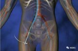 CardioMEMS心衰监测传感器安全可靠,?#34892;?#38477;低住院率