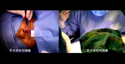 山东电信助力千佛山医院完成了微笑一生唇腭裂5G手...