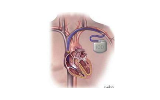 埋藏式心脏复律除颤器（ICD）的基本结构与功能详...