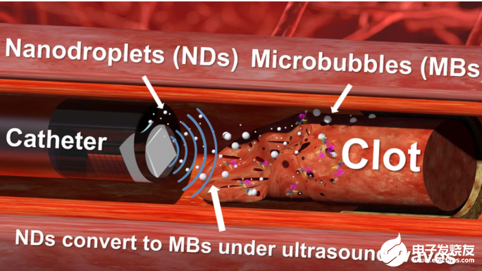 科学家展示可清除顽固血凝块的超声波钻头