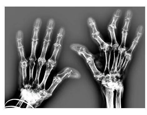 3D打印个性化手指关节