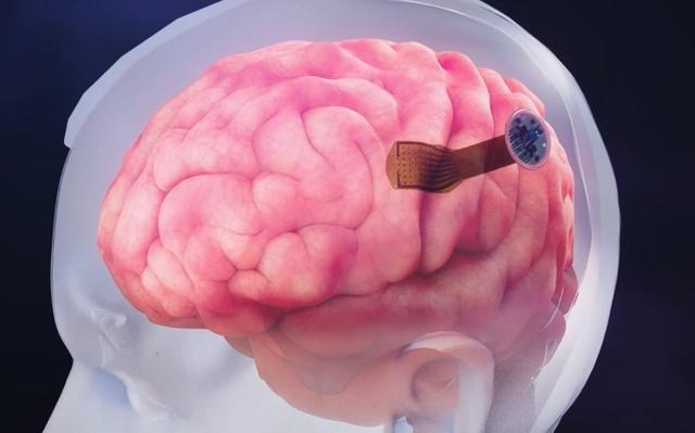 脑机接口最新科研进展，以“半侵入性”方式植入大脑！-脑机接口植入人脑